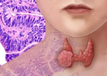 أعراض سرطان الغدد الليمفاوية