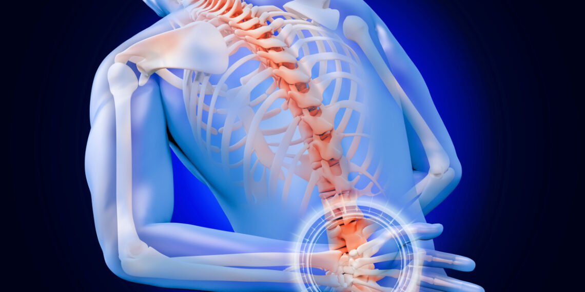 علاج عرق النسا بالأعشاب