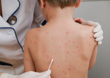 جدري القرود