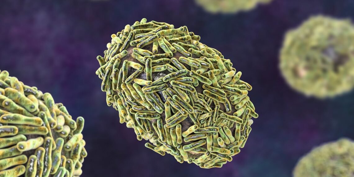 جدري القرود