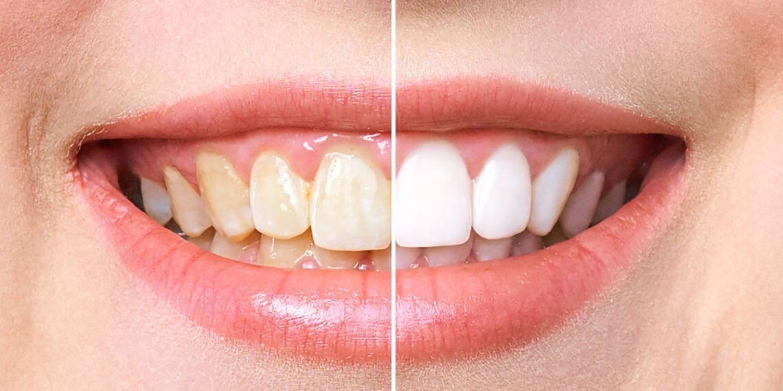 طريقة تبييض الأسنان في يوم واحد