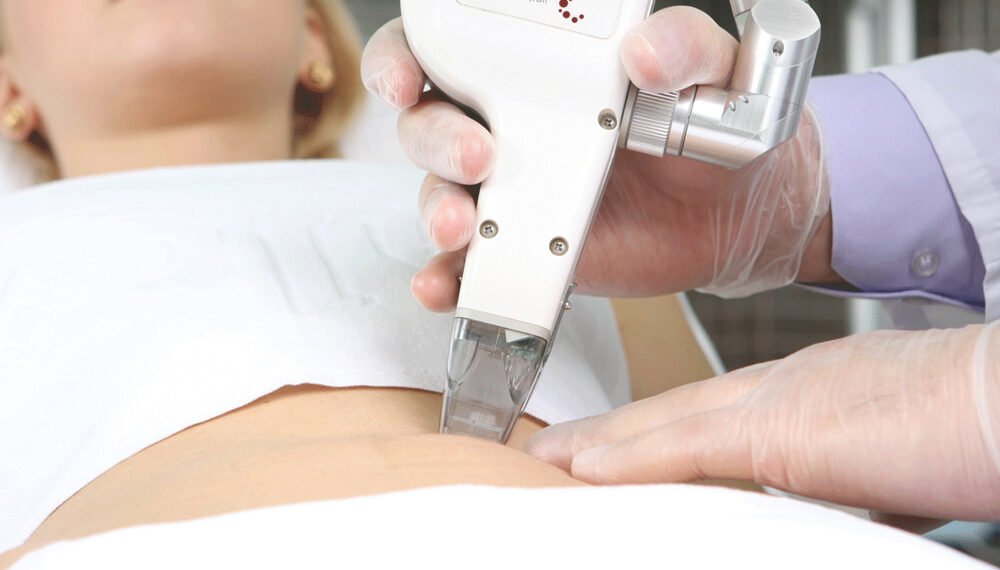 هل الليزر يؤثر على المبايض