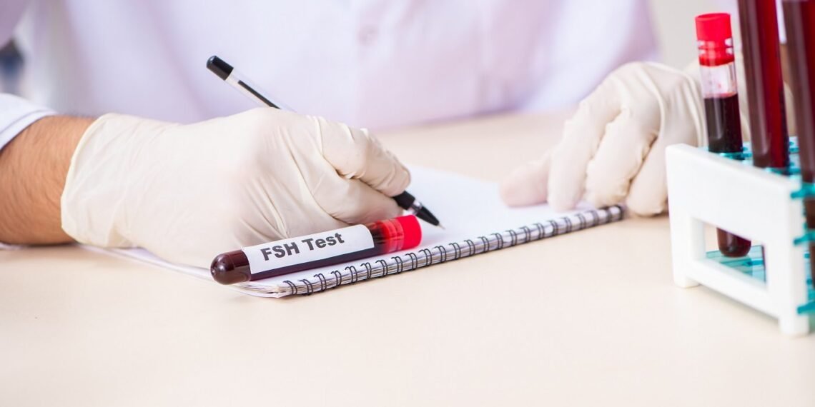 علاج ارتفاع هرمون FSHعند الرجال