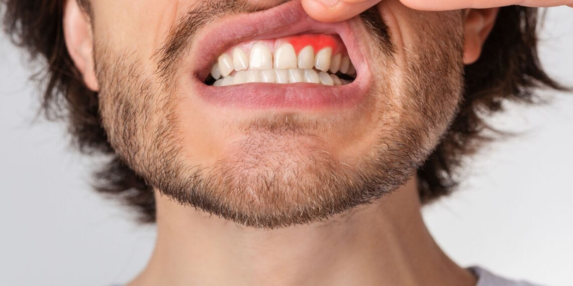 أسباب التهاب اللثة