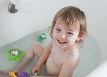 أعراض الجدري عند الأطفال