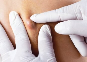 أفضل مرهم لعلاج الدمامل