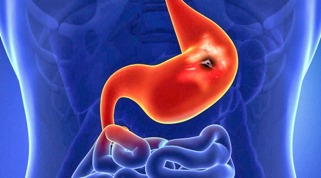 علاج قرحة المعدة بالأدوية والطب النبوي البديل